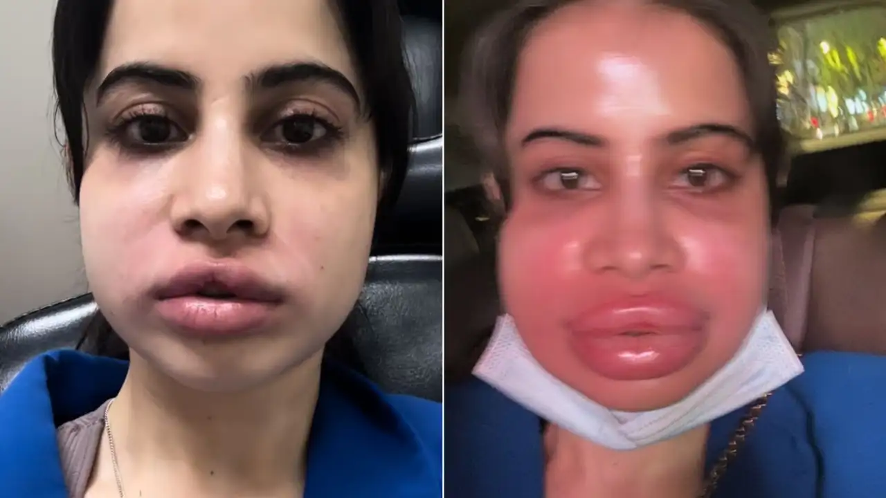 Uorfi Javed Undergoes Painful Lip Filler